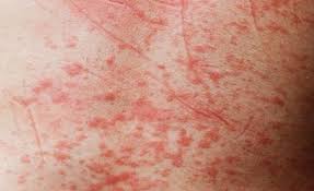 وزارة الصحة : ظهور بؤر لحمى الوادي المتصدع في نواكشوط