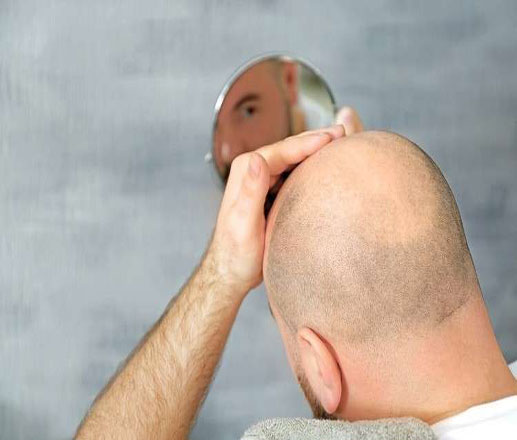 ابتكار مستحضر يكافح الصلع