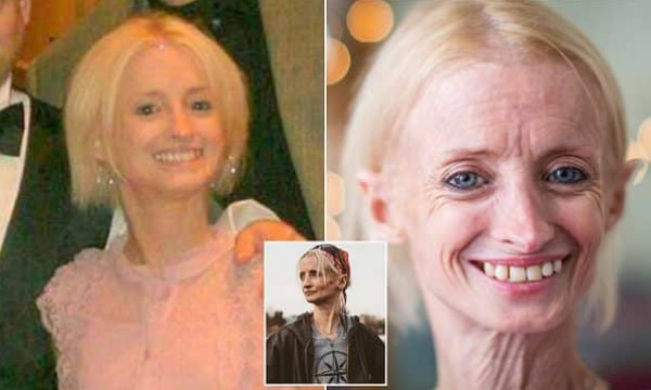 سيدة تكبر في عمرها 8 مرات.. حالة نادرة بين 50 مليون شخص