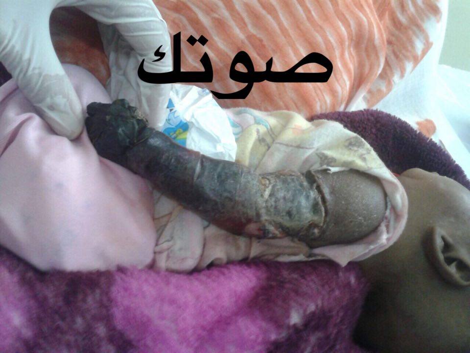 ممرض يتسبب في بتر ذراع طفل رضيع(خاص)