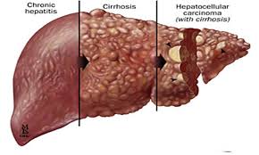 دراسة: ربع سكان موريتانيا مصابون بالتهاب الكبد الوبائي